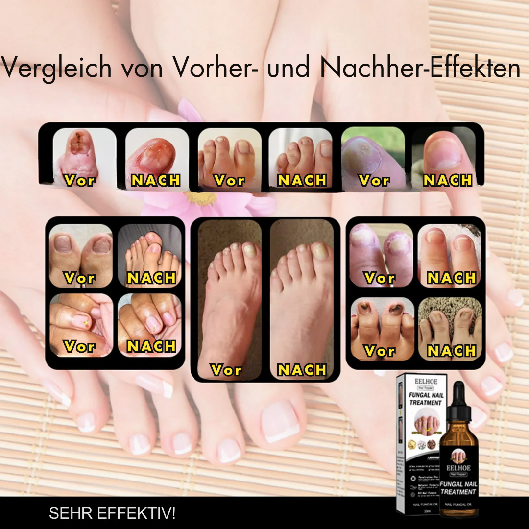 Nail Repair™ | Schädliche Nägel behandeln (1+1 GRATIS)